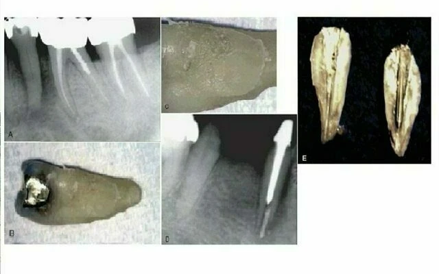 điều trị nội nha - nứt dọc chân răng