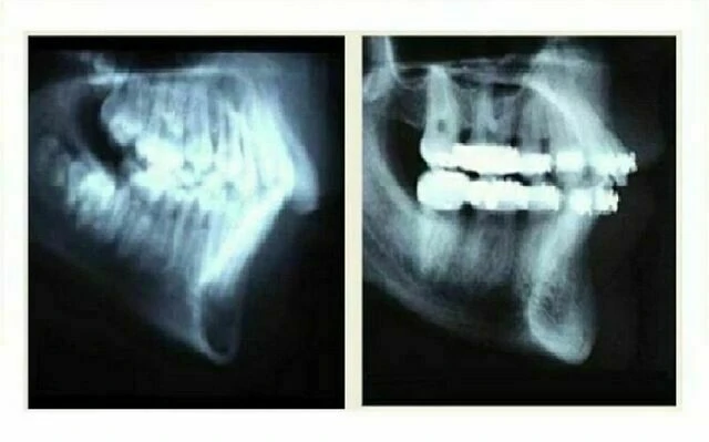 Phân tích phim sọ nghiêng