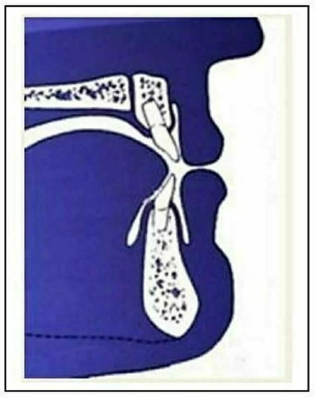 Chỉnh nha - Khoảng hở theo mặt phẳng ngang