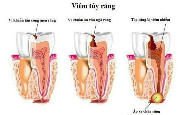 triệu chứng của bệnh lý tủy
