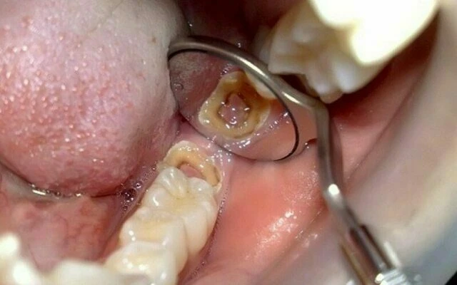 điều trị nội nha