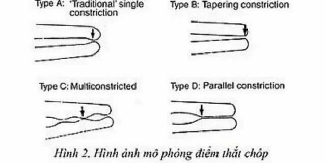 điểm thắt chóp
