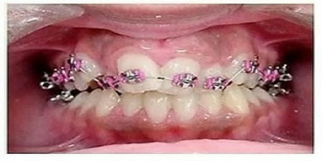 tự học chỉnh nha - Trình tự thay dây theo giai đoạn