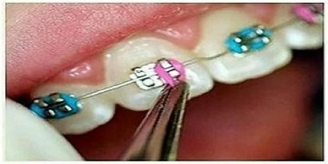 tự học chỉnh nha - dây cung nằm thụ động trong khe mắc cài