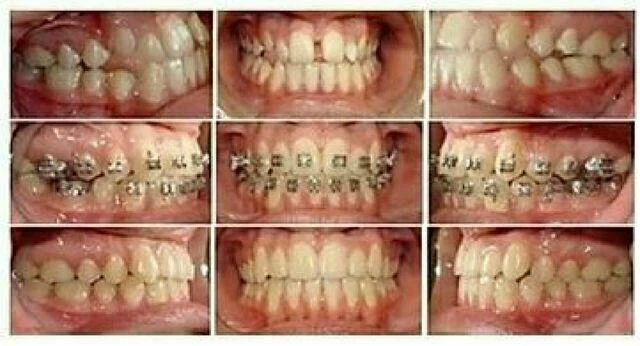 tự học chỉnh nha