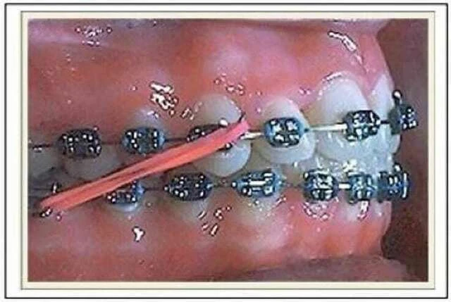 tự học chỉnh nha - chun