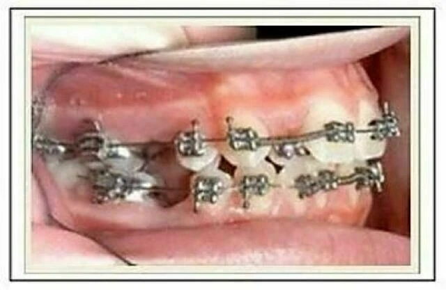 tự học chỉnh nha - lò xo, chun