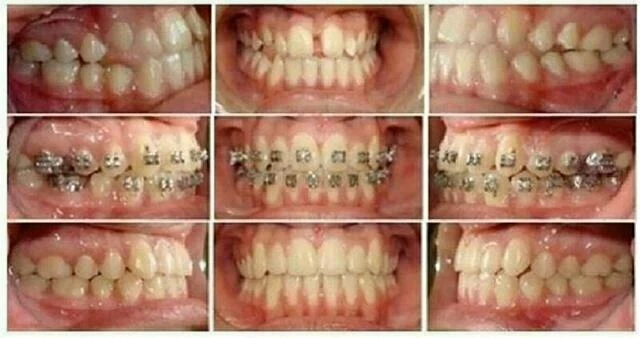 tự học chỉnh nha - lò xo