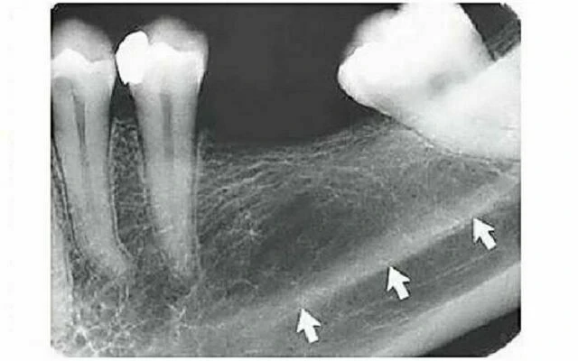 Hõm tuyến dưới hàm