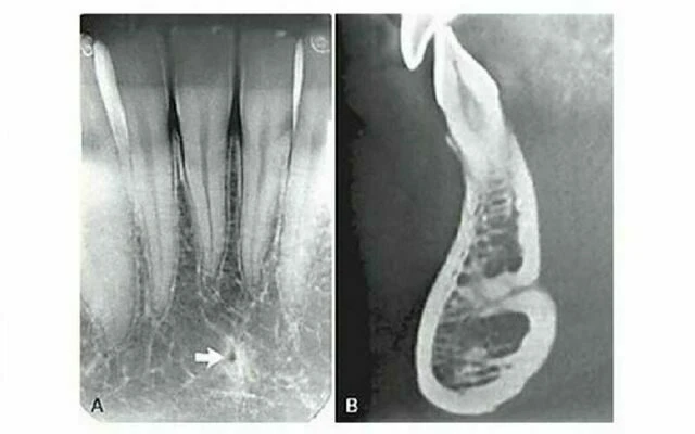 xương hàm dưới