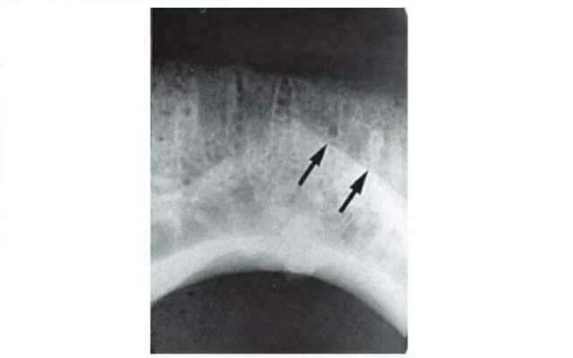 xương hàm dưới