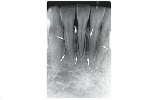 xương hàm dưới