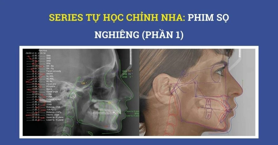 Series tự học chỉnh nha: phim sọ nghiêng (phần 2) - 11