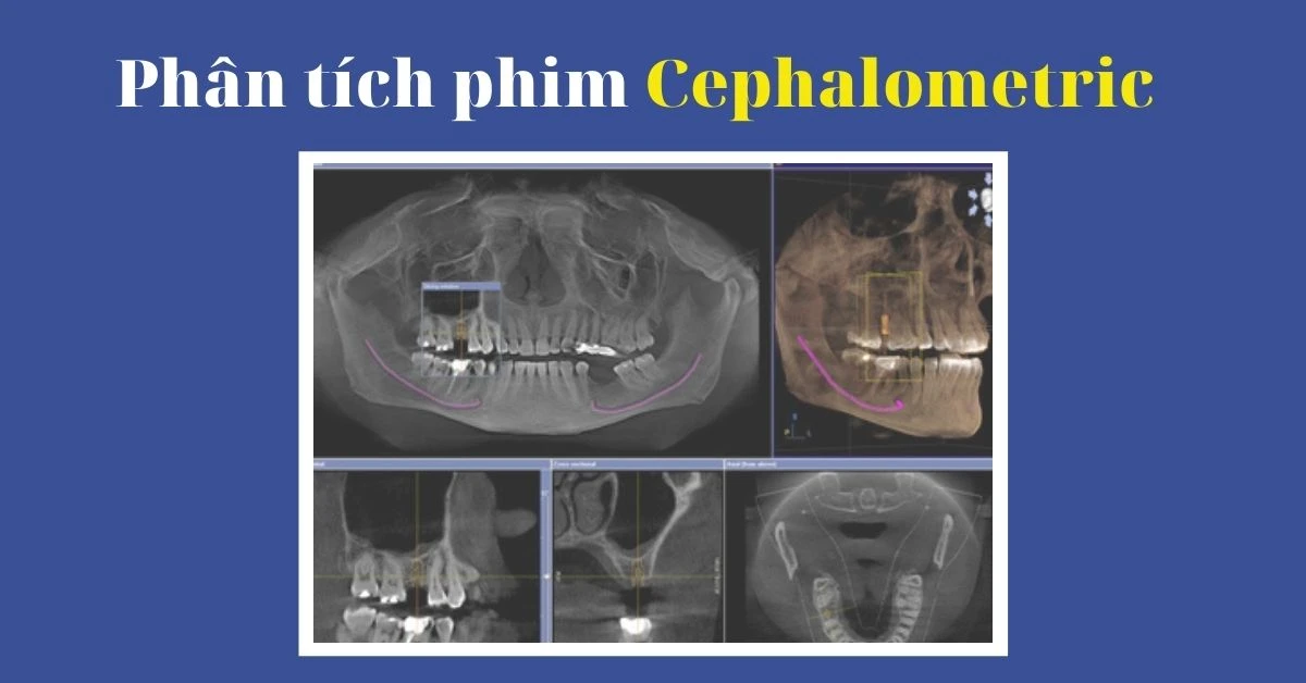 Phân tích phim Cephalometric