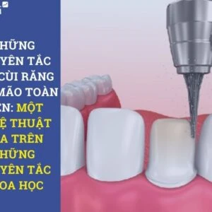 Những nguyên tắc mài cùi răng cho mão toàn diện: một nghệ thuật dựa trên những nguyên tắc khoa học