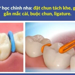 Series tự học chỉnh nha: đặt chun tách khe, gắn khâu, gắn mắc cài, buộc chun, ligature. - 6