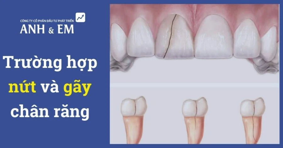 Trường hợp nứt và gãy chân răng