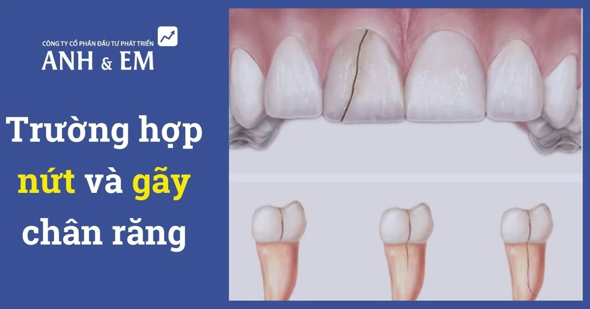 Trường hợp nứt và gãy chân răng