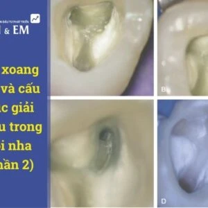 Mở xoang tủy và cấu trúc giải phẫu trong nội nha (phần 2) - giải phẫu - Mo xoang tuy va cau truc giai phau trong noi nha phan
