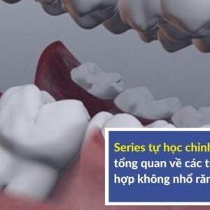 Series tự học chỉnh nha: tổng quan về các trường hợp không nhổ răng - lý thuyết - Series tu hoc chinh nha tong quan ve cac...