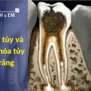 Sỏi tủy và sơ hóa tủy răng