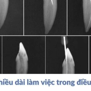 Xác định chiều dài làm việc trong điều trị nội nha