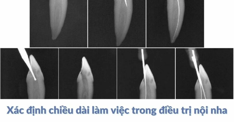 Xác định chiều dài làm việc trong điều trị nội nha