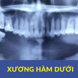 Xương hàm dưới - giải phẫu (phần 1) - Xuong ham duoi