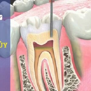 Điều trị tủy lại răng 47 - ca lâm sàng thực tế - Dieu tri tuy lai rang 47