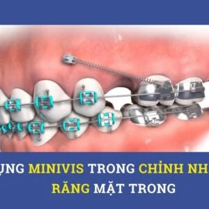 Sử dụng minivis trong chỉnh nha niềng răng mặt trong