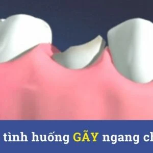 Xử lý tình huống gãy ngang chân răng - cấp cứu - Xu ly tinh huong gay ngang chan rang