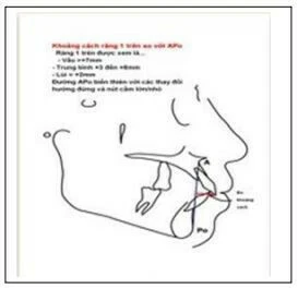 Viêm nhiễm phần mềm vùng miệng - hàm mặt dấu hiệu chức năng