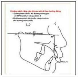 mặt viêm mô tế bào