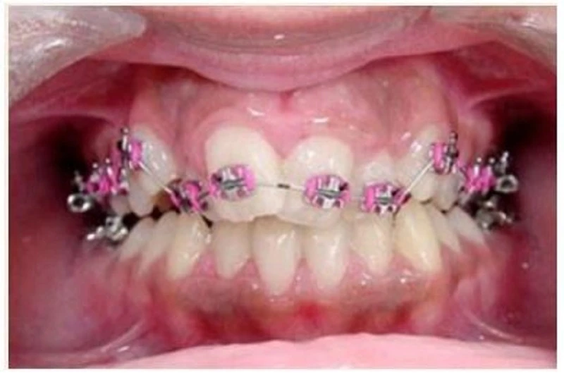 Giai đoạn làm thẳng (alignment) và làm phẳng cung răng