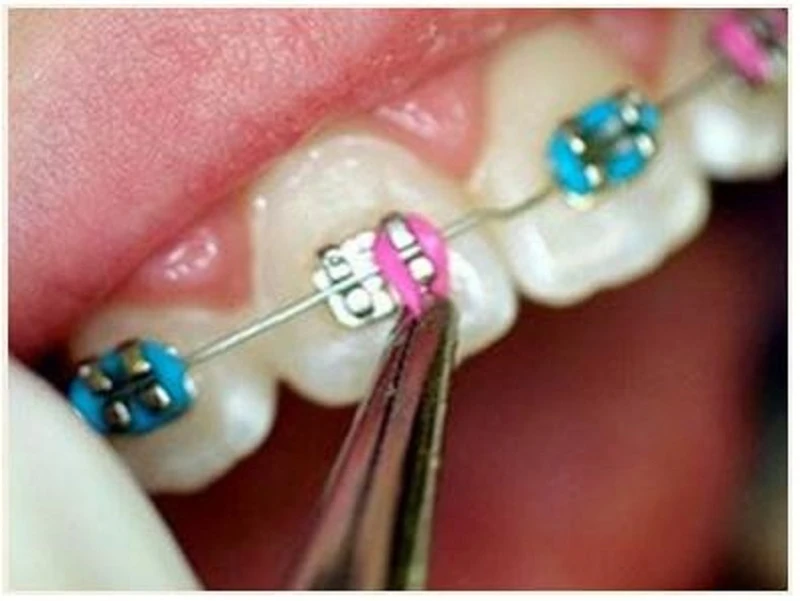 Buộc dây cung hoàn toàn.