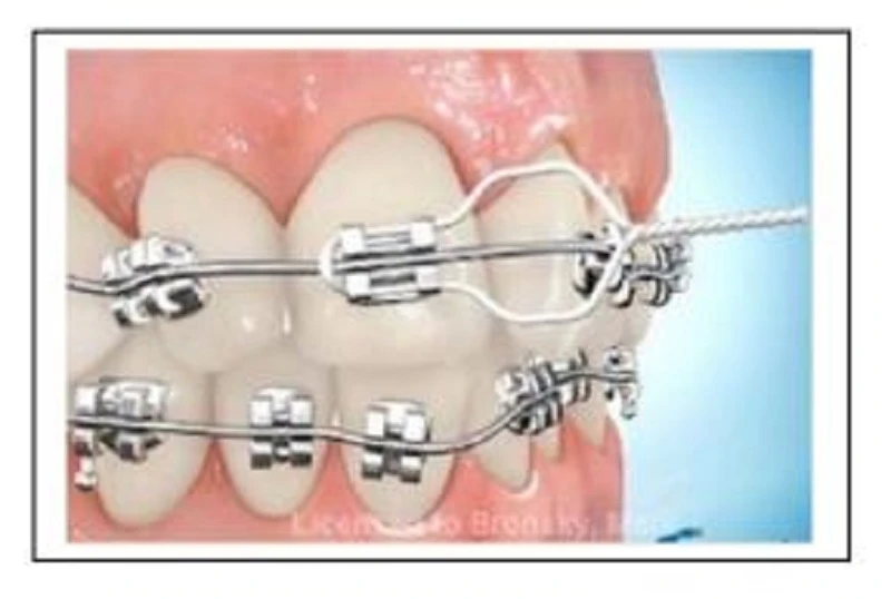 SERIES TỰ HỌC CHỈNH NHA: TRÌNH TỰ DÂY CUNG CHUẨN dây cung nằm thụ động trong khe mắc cài