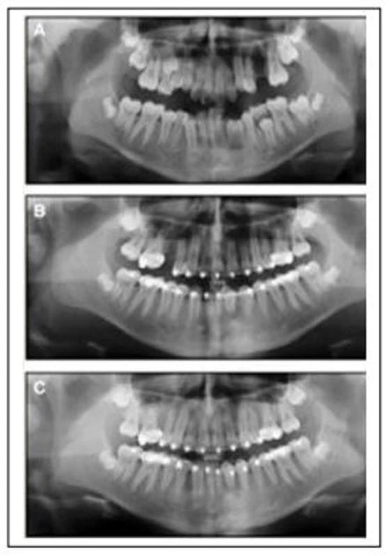 SERIES TỰ HỌC CHỈNH NHA: TRÌNH TỰ DÂY CUNG CHUẨN X quang dây cung Niti