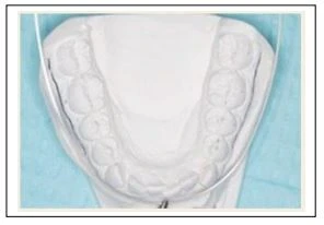 SERIES TỰ HỌC CHỈNH NHA: NHỔ RĂNG HAY KHÔNG? Nọng rông cung hàm