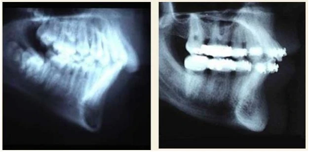 phân tích phim đo nghiêng