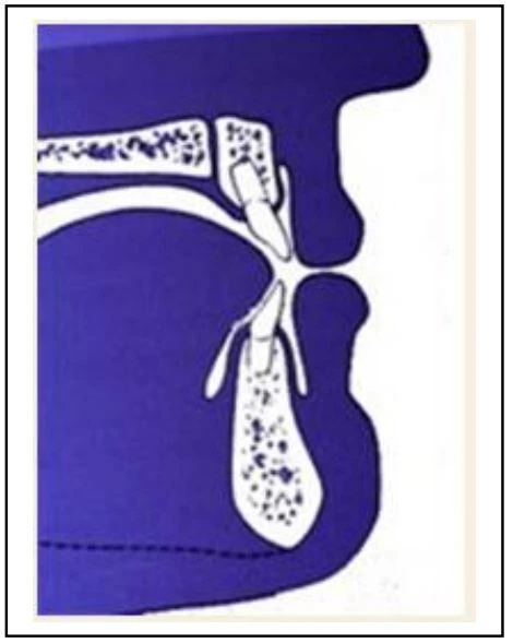 SERIES TỰ HỌC CHỈNH NHA: NHỔ RĂNG HAY KHÔNG? khoang hở theo mặt phẳng ngang