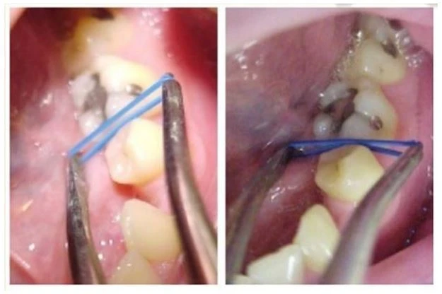 bằng kìm đặt chun