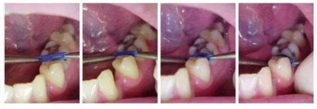 dùng kẹp mosquito