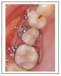 SERIES TỰ HỌC CHỈNH NHA: ĐẶT CHUN TÁCH KHE, GẮN KHÂU, GẮN MẮC CÀI, BUỘC CHUN, LIGATURE. Gắn chun chuối vào