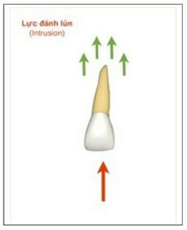 biểu đồ ống tủy