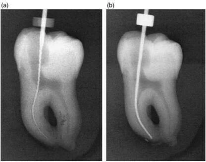 Sự dịch chuyển ống tủy trong điều trị nội nha ảnh chụp xquang ban đầu