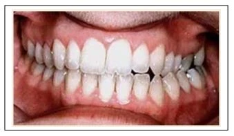 SERIES TỰ HỌC CHỈNH NHA - BÀI 1 : KHÁM LÂM SÀNG Functional Shift - trượt chức năng/lệch chức năng.