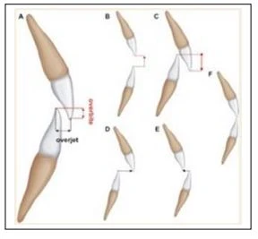 SERIES TỰ HỌC CHỈNH NHA - BÀI 1 : KHÁM LÂM SÀNG Cắn phủ: Cắn hở, Cắn trung bình, cắn sâu