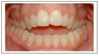 răng bị lộ khi cắn khớp