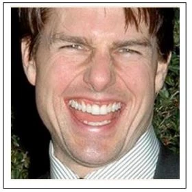 Để làm thẳng các răng chen chúc