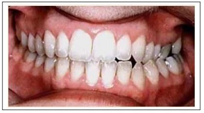 Cắn chéo phía lưỡi.